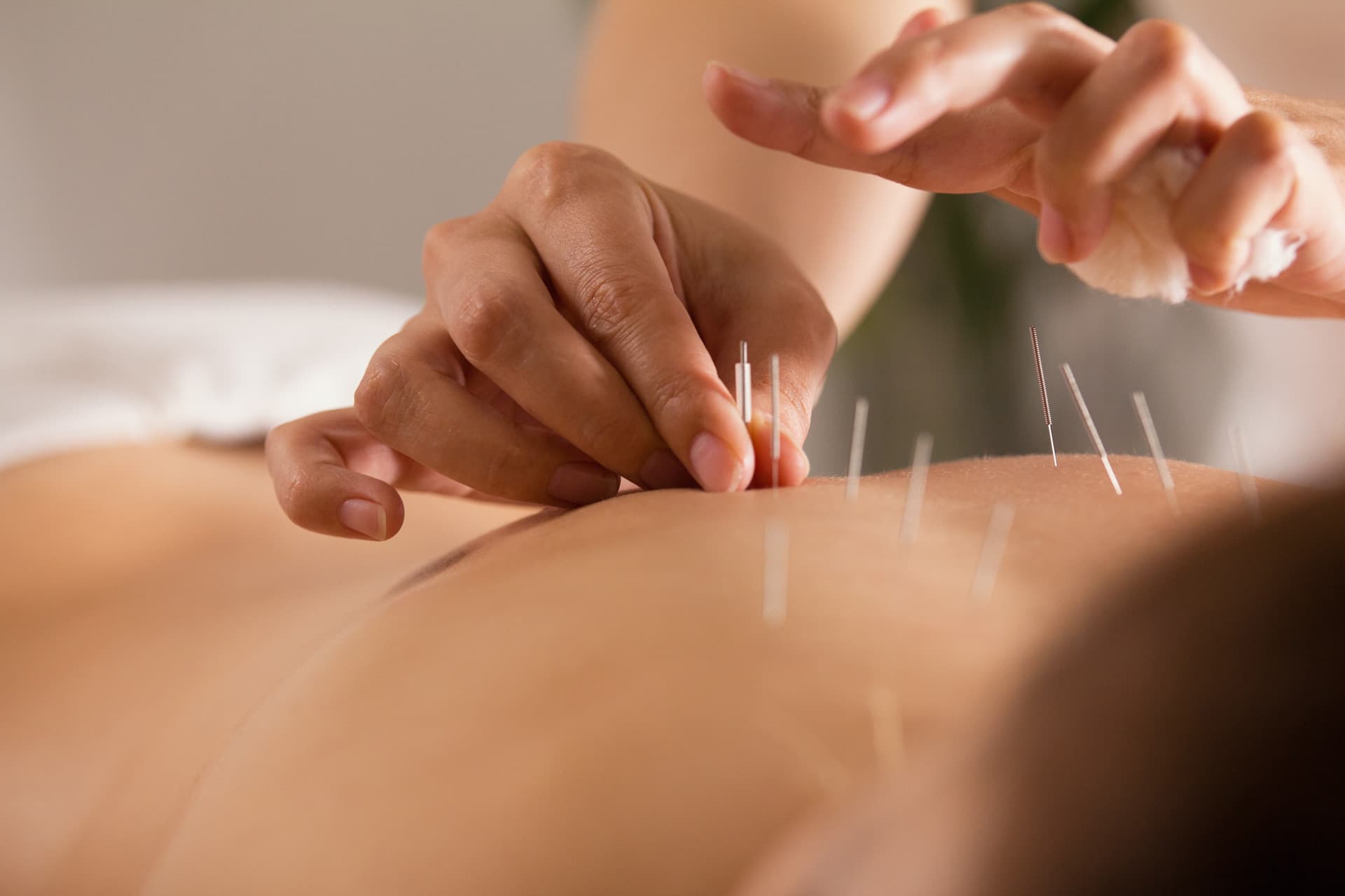 Conoce los beneficios de la acupuntura